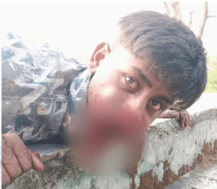 A young man's hero act proved fatal for him. 18-year-old Rohit was bursting a firecracker in his mouth, resulting in a powerful explosion that shattered his jaw.